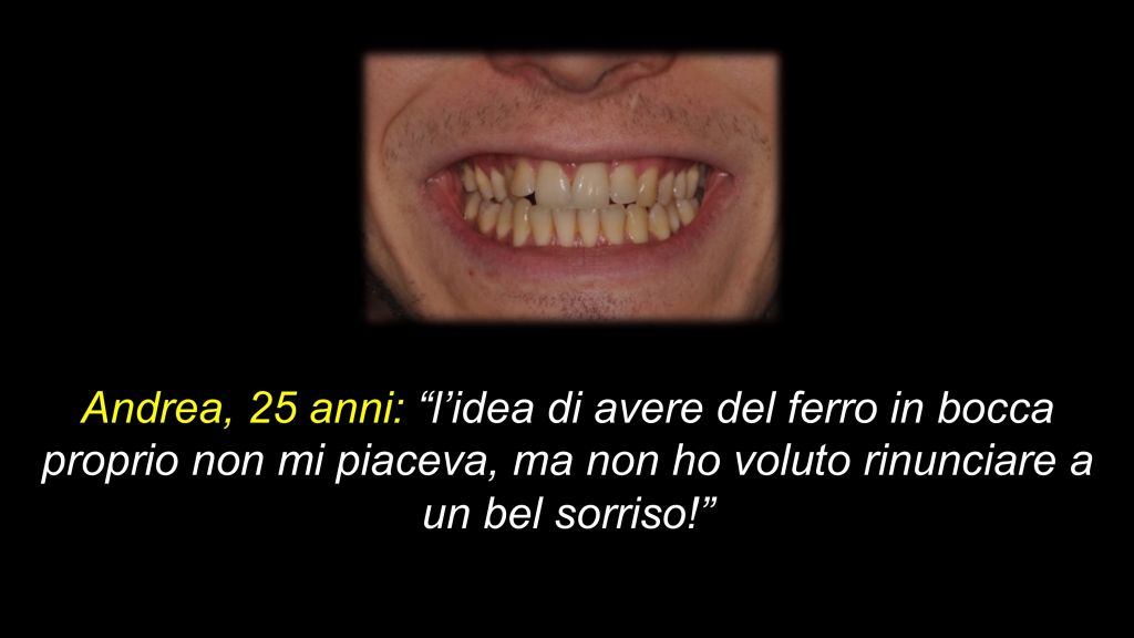 Ortodonzia invisalign Bologna - Ortodonzia Invisalign Bologna