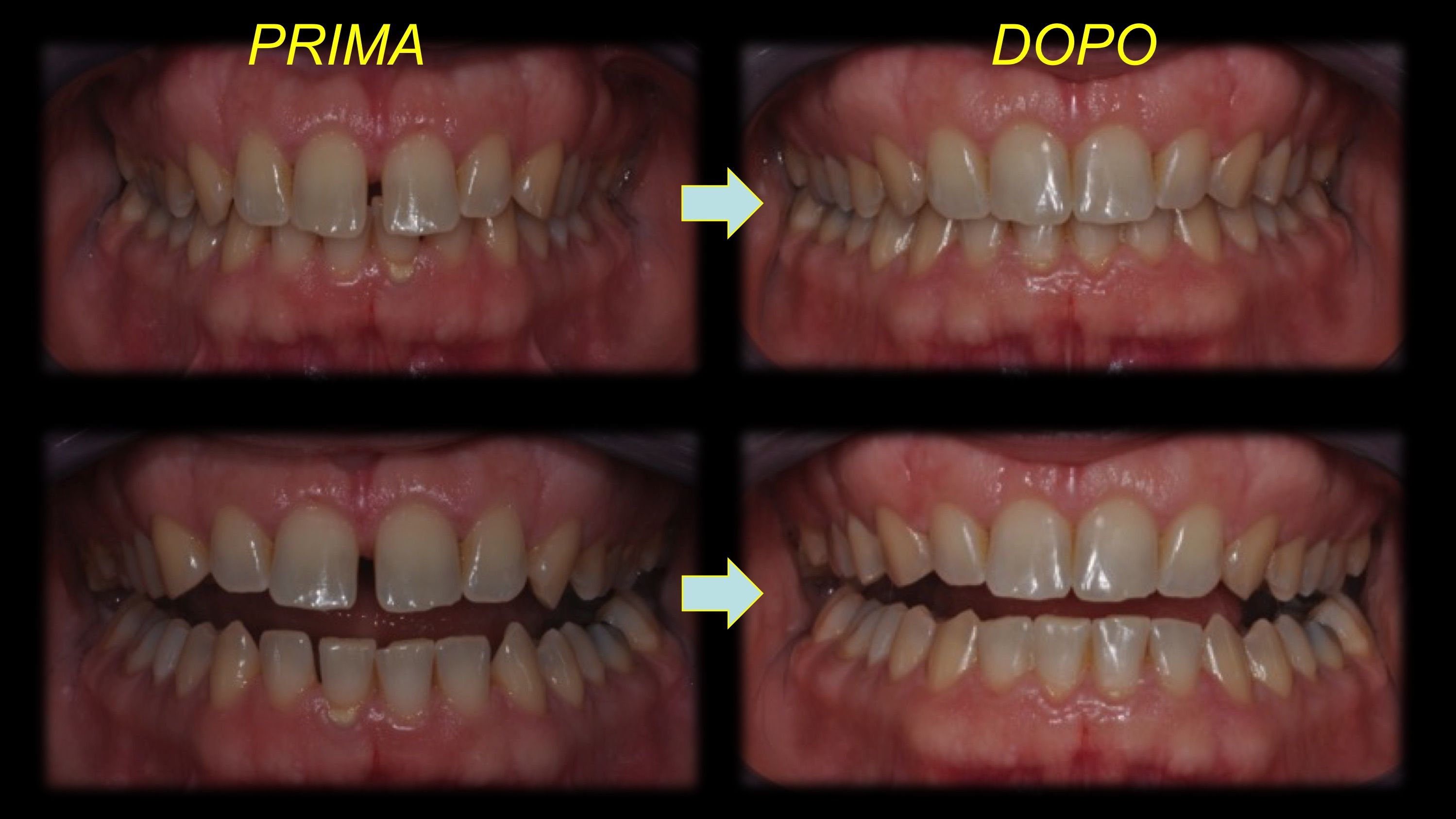 Risultati Invisalign - Ortodonzia Invisalign Bologna